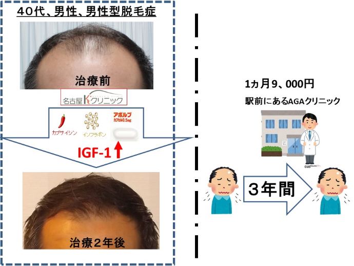 円形脱毛症　病院